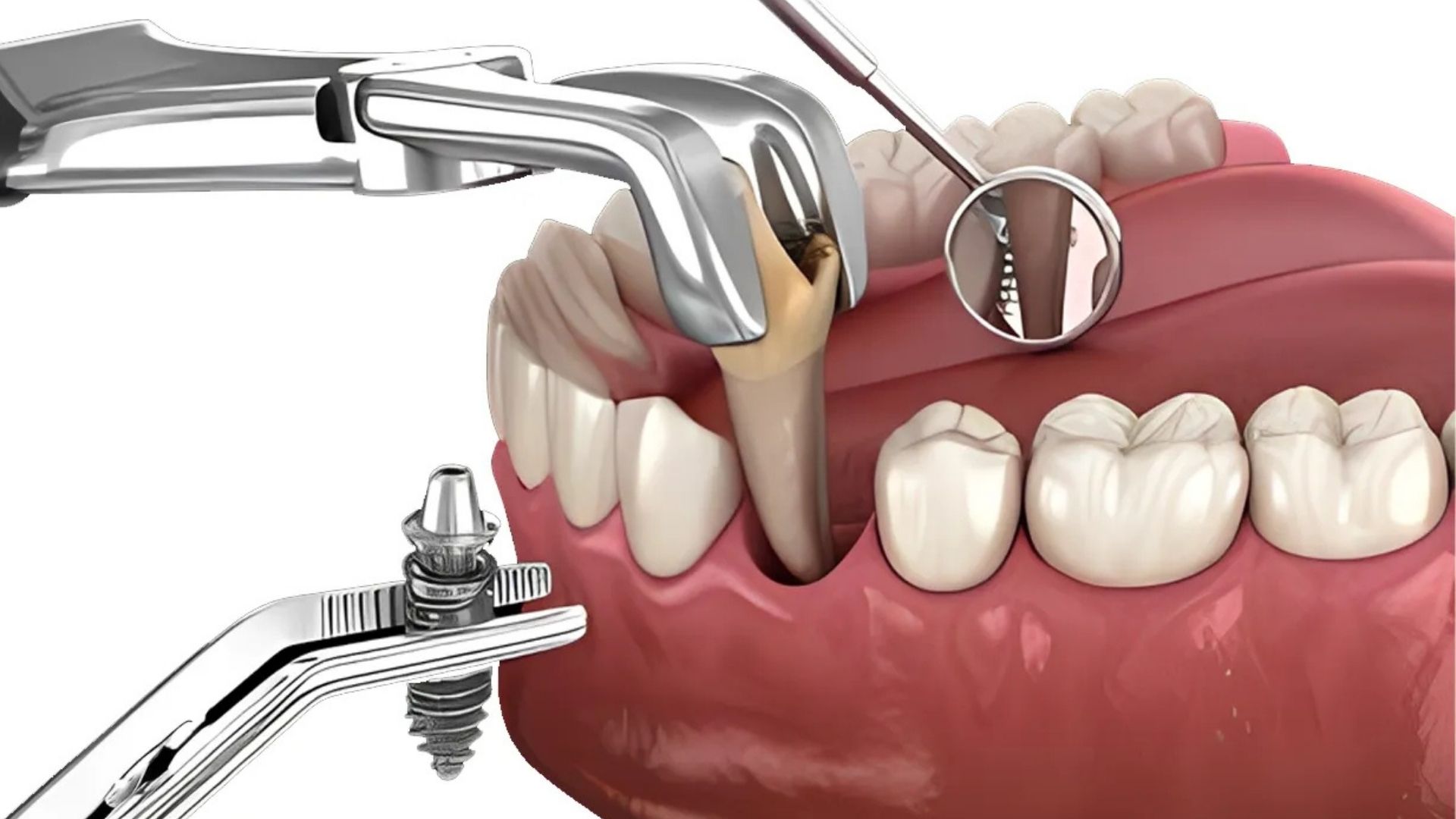 Immedita Implant / Implant in a Day