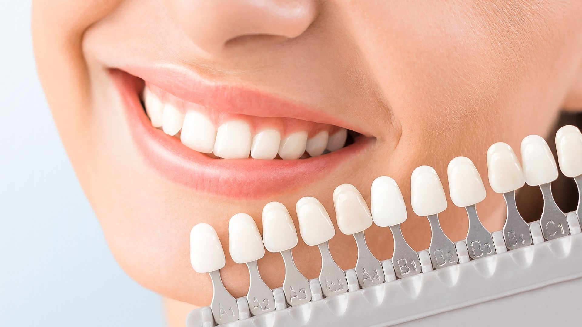 Porcelain Lamina & Laminate Venee